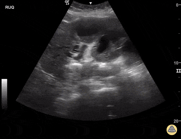 Cholangiocarcinoma with Metastases