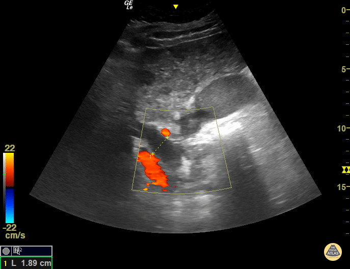 Dilated Common Bile Duct