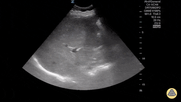 Cholecystitis - Emphysematous