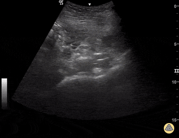 Hemorrhagic Cyst and Subchorionic Hemorrhage