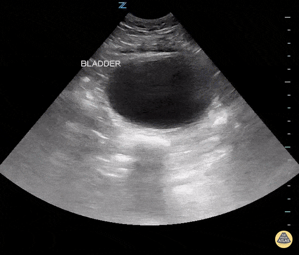 Large Prostate