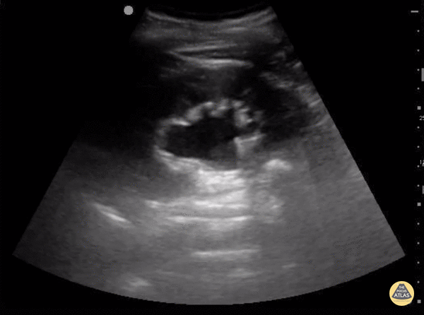 Moderate Hydronephrosis