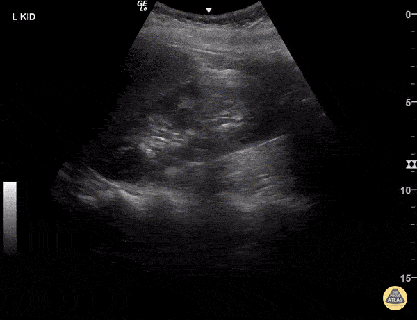 Normal Kidney