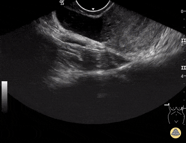 Ovarian Cyst