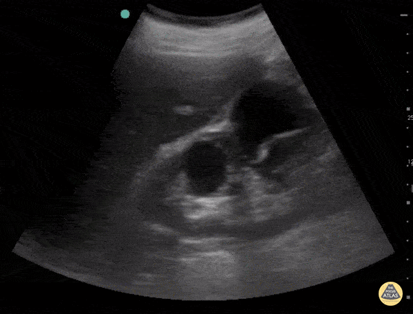 Renal Cysts