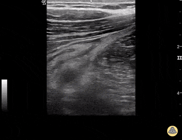 Retrocecal Appendendictis