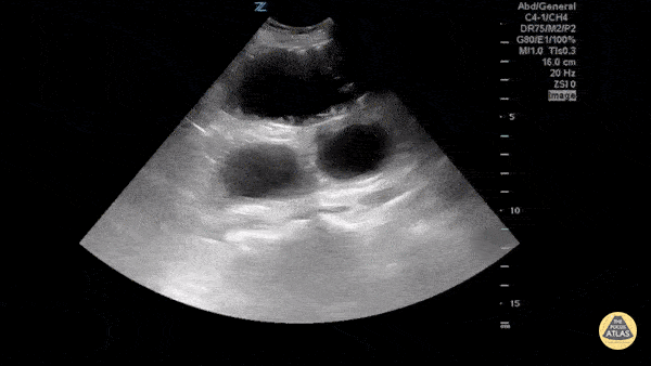 Small Bowel Obstruction