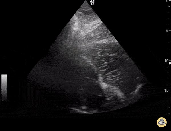 Asystole