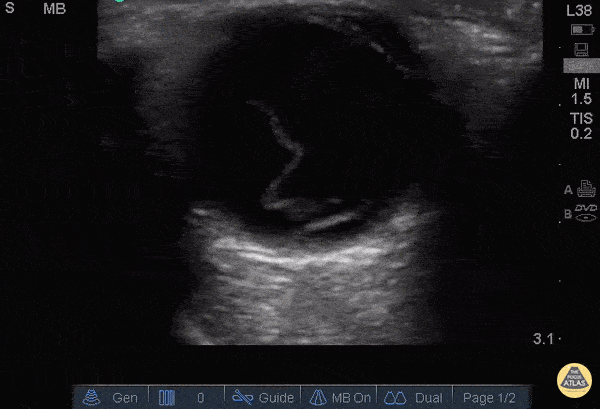 Retinal Detachment