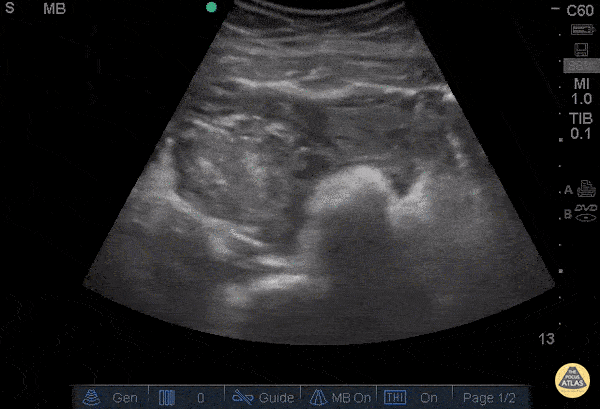 Ruptured Ovarian Cyst - Hematoma