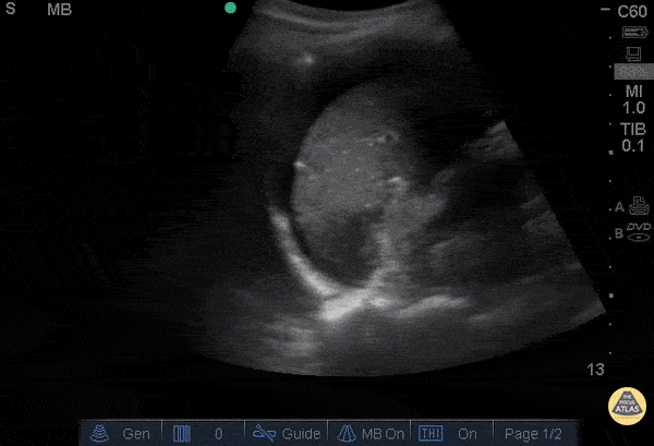 Positive FAST in LUQ - Ruptured Ovarian Cyst