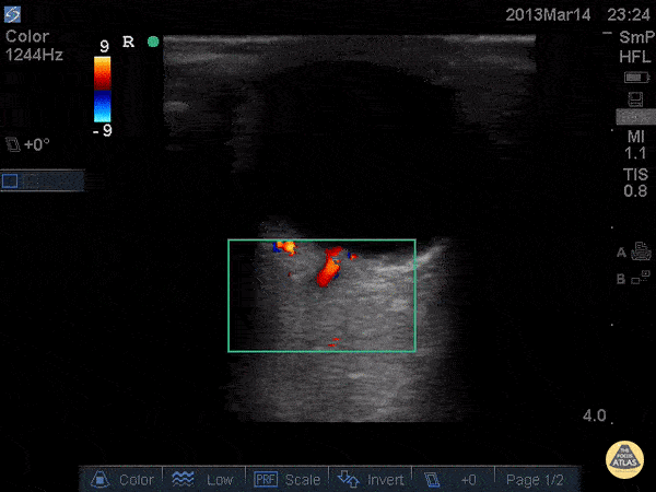 Central Retinal Artery and Venous Flow - Normal