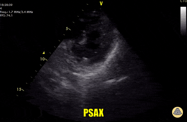 Asystole