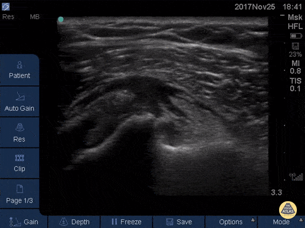 Subscapularis Tendinopathy