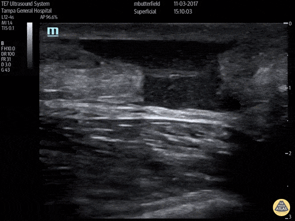 Achilles Rupture (Long Axis)