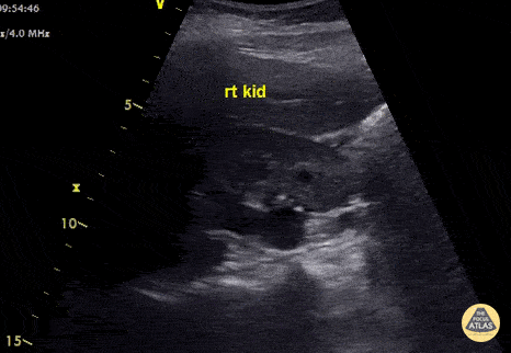 Hydroureter with Moderate Hydronephrosis