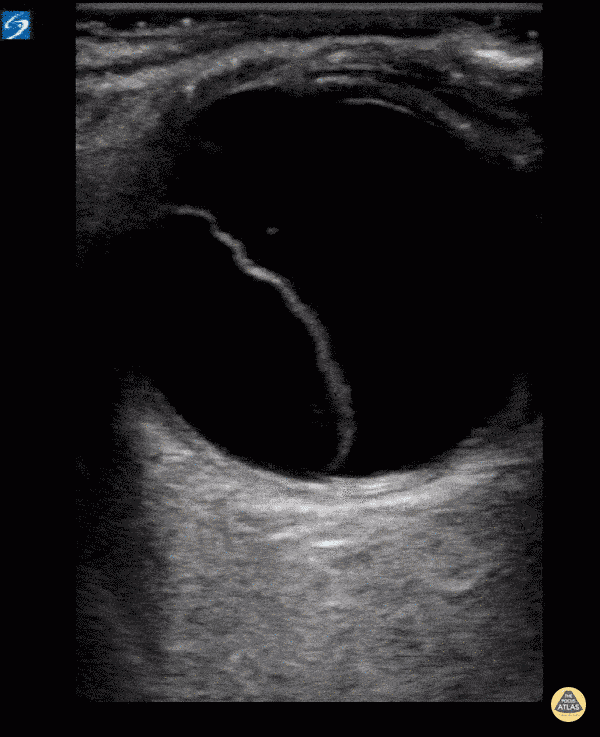 Retinal Detachment Ultrasound