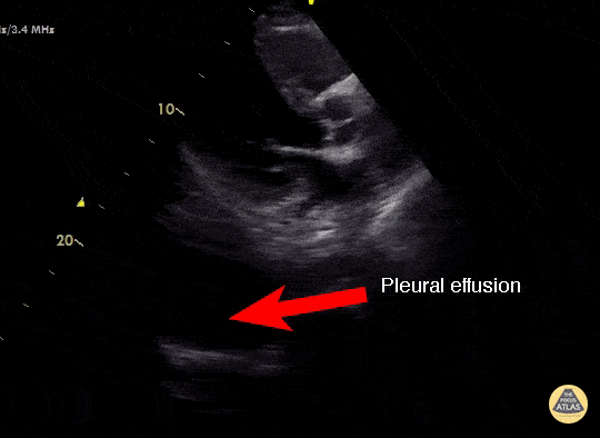 Concealed Pleural Effusion