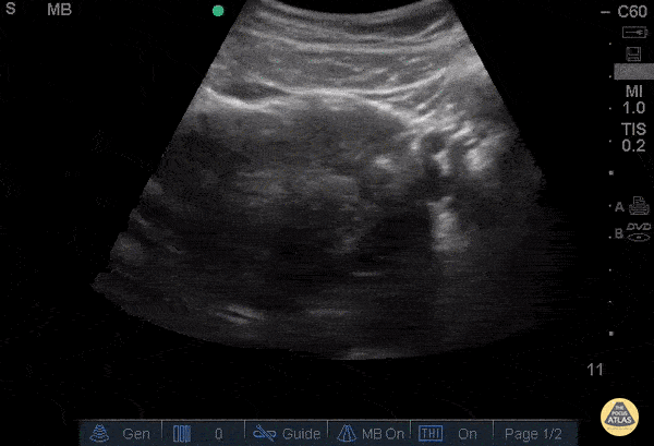 Ectopic - Ruptured Cornual Ectopic Pregnancy