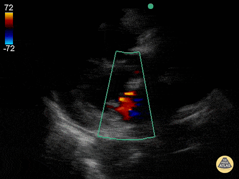 Aortic and Mitral Regurgitation