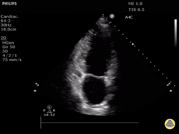 Normal Apical 2 Chamber View