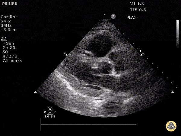Acute Cor Pulmonale (Parasternal Long-Axis View)