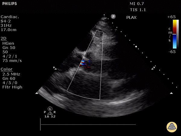 Moderate Aortic Regurgitation