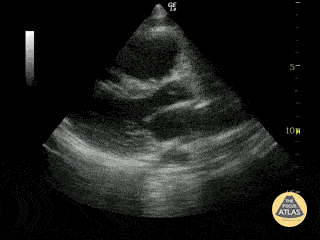 Cardiac Arrest with Agonal Rhythm
