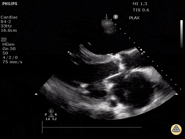 Valvulopathy — TPA