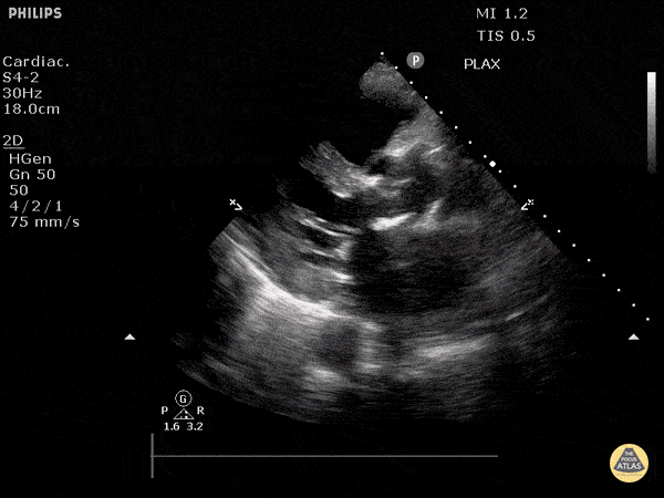 Valvulopathy — TPA