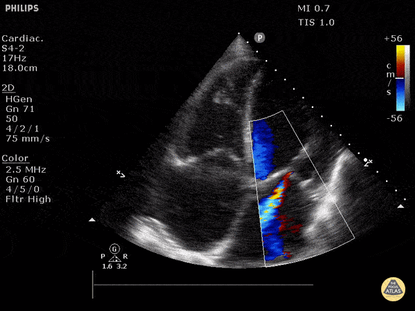 Echocardiography — TPA