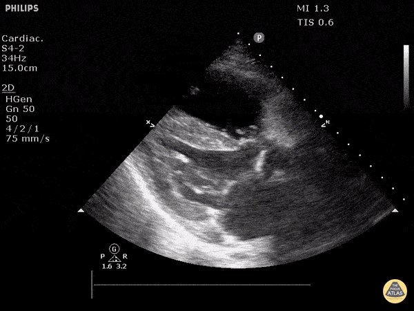 Cor Pulmonale (Long)