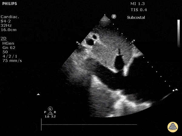 Plethoric Inferior Vena Cava