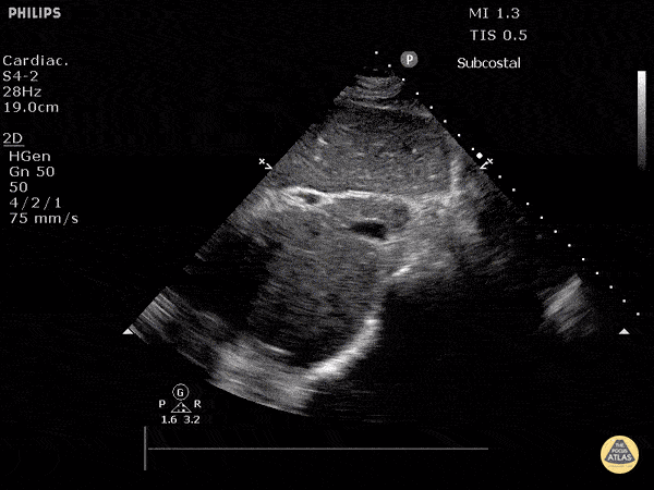 Inferior Vena Cava in Hypovolemia