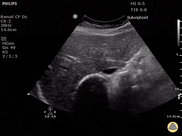 Inferior Vena Cava in Hypovolemia (Transverse)