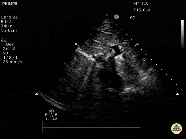 Normal Inferior Vena Cava