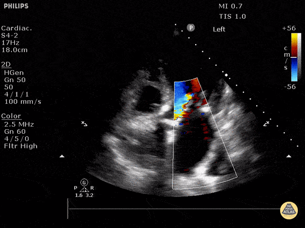 Valvulopathy — TPA