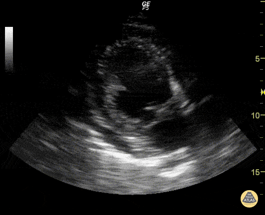 Mitral Valve Prolapse (Apical Long-Axis View)
