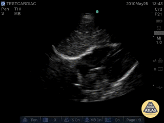 Normal Subcostal View