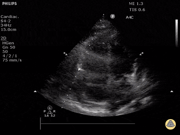 Pericardial Disease — TPA