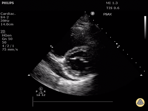Cardiac Tamponade (Parasternal Short-Axis View)
