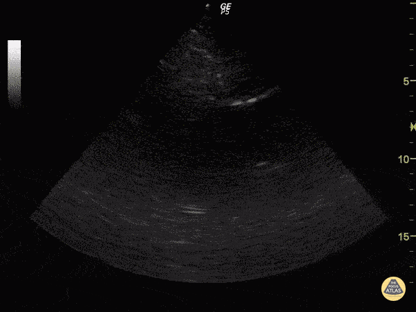 Cardiac Tamponade in Stabbed Patient