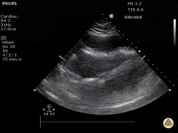 Cardiac Tamponade