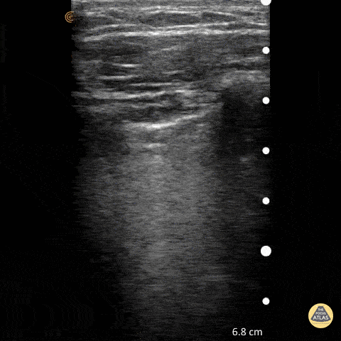 Normal Lung Slide