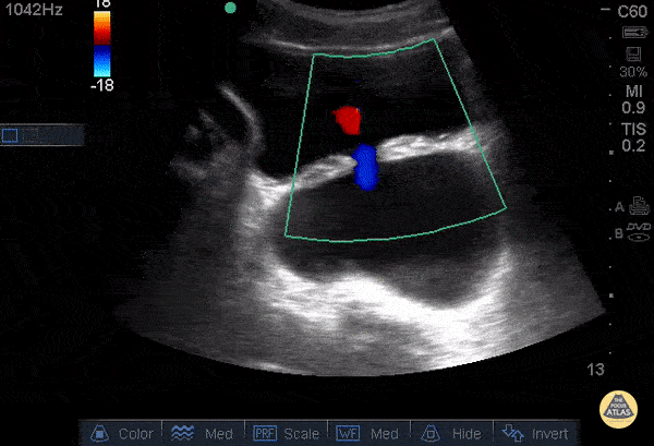 Bladder Diverticulum