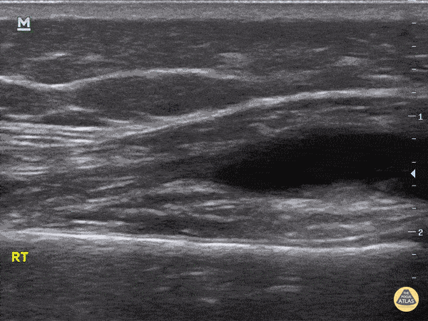 Knee Effusion - Septic vs. Lyme Arthritis
