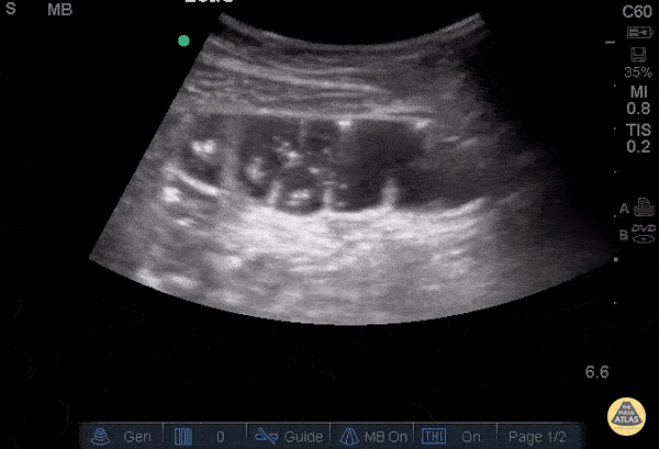 Incarcerated Hernia with SBO
