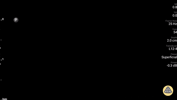 Panniculitis