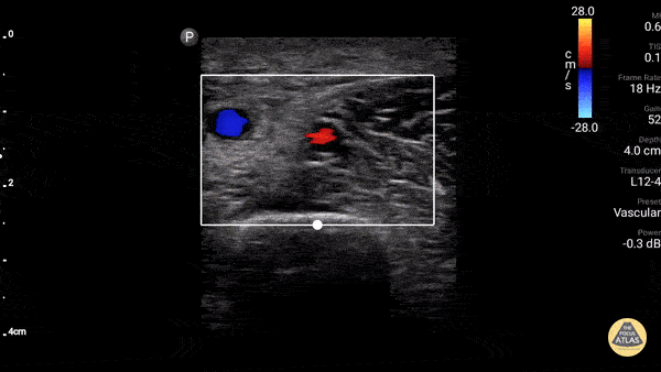 Axillary Vein (Normal Compressible)