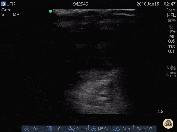 Testicular Rupture